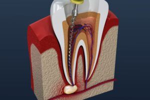 root canal therapy on tooth
