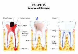 process of root canal therapy